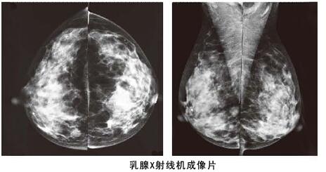 數(shù)字化鉬靶乳腺機